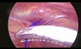 Laparoscopic Needle-Assisted Repair of Inguinal Hernia (LNAR)