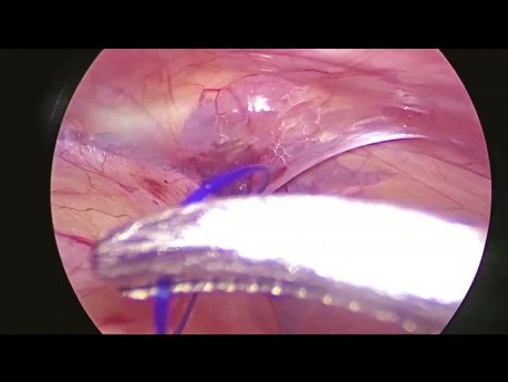 Laparoscopic Needle-Assisted Repair of Inguinal Hernia (LNAR)