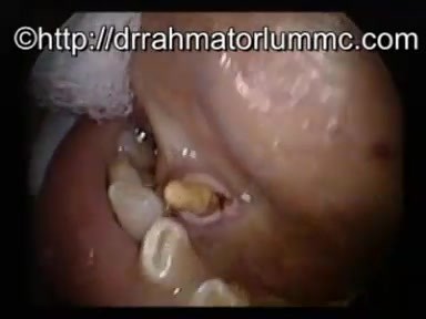 Left submandibular duct stone