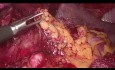 Laparoscopic D2 Gastrectomy - Key Steps of the Procedure