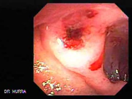 Duodenal Ulcer and Bleeding (7 of 23)