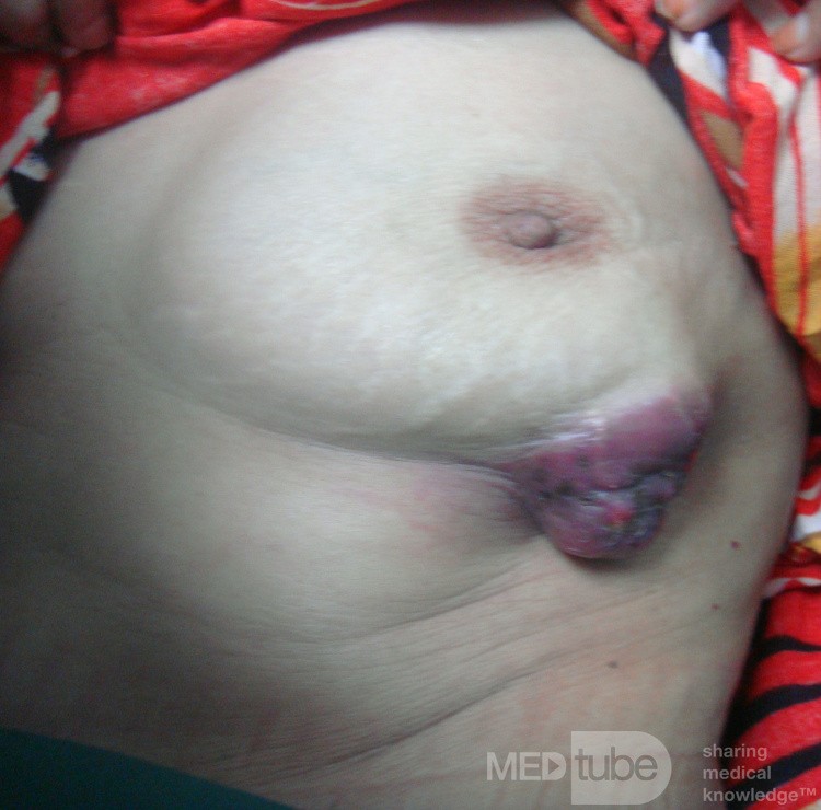 Breast Cancer Locally Advanced