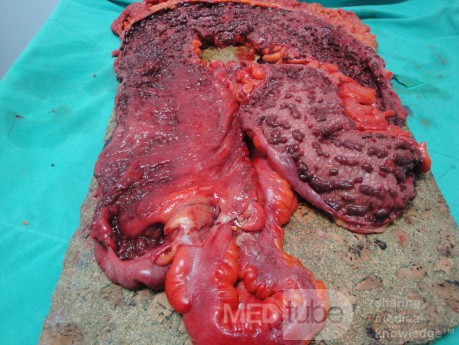 Multiple Rectal Ulcers (92 of 110)