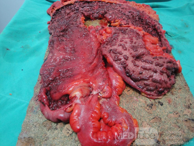 Multiple Rectal Ulcers (92 of 110)