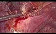 Laproscopic Uterovesical Fistula Repair