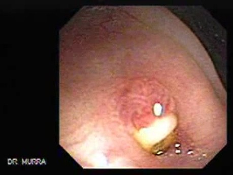 Diverticulitis (1 of 4)