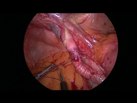 Laparoscopic Management of a Strangulated Internal Hernia Underneath the External Iliac Artery with Parietal Peritoneal Patch Reconstruction
