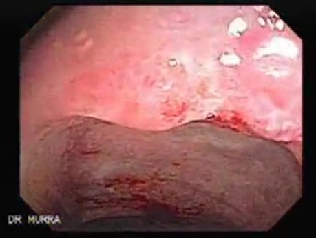 Endoscopic Resection of Giant Tubulo-Villous of the rectum (32 of 35)