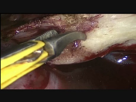 TLH in c/o 32 Wks Size Uterus