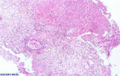 Barrett's Ulcer (2 of 5 )