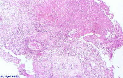 Barrett's Ulcer (2 of 5 )