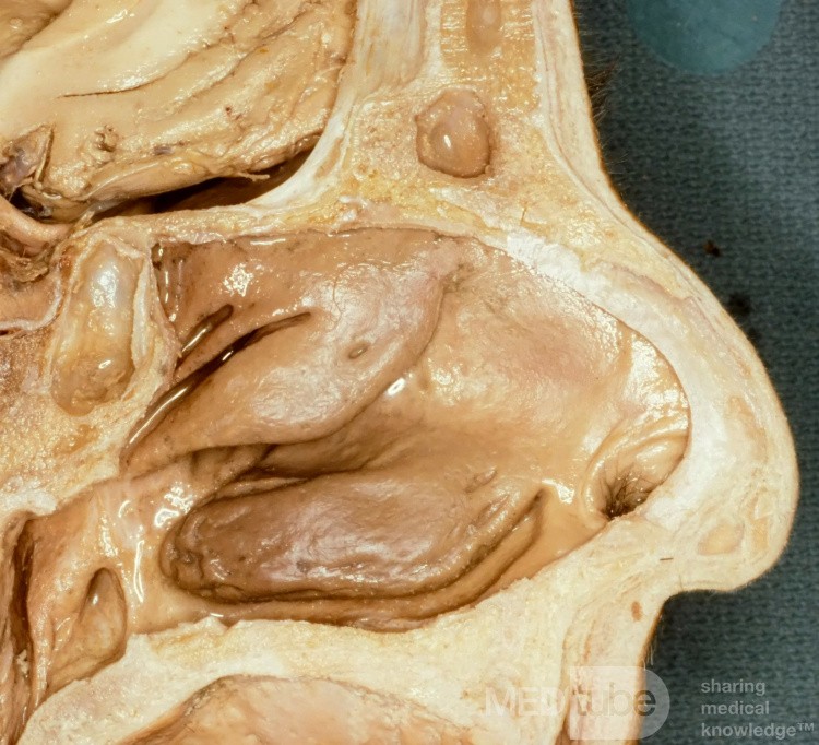 The Lateral Wall of the Nose Unlabelled [Cadaveric Specimen]