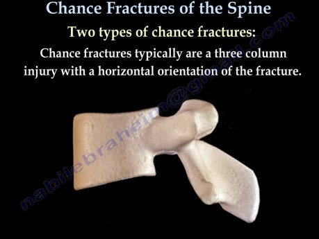 Spine Injuries - Chance Fractures - Video Lecture