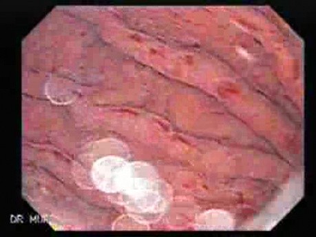 Acute Gastritis (Pangastritis) (10 of 10)