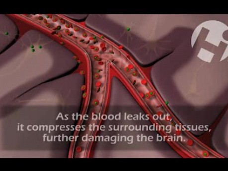Neurologic Injury