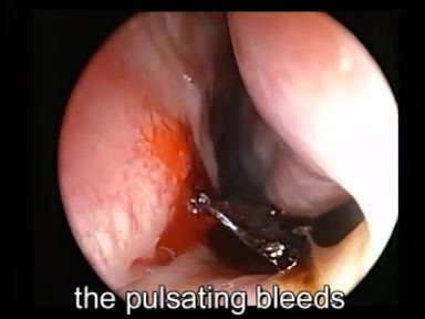 Nosebleed - Cauterization With TCA 50% • Video • MEDtube.net