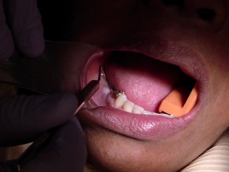 Implants And Attached Gingiva