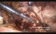 Laparoscopic Repair of a Symptomatic Post Cesarean Isthmocele
