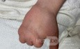 Burned Hand Reconstruction on Syrian Girl