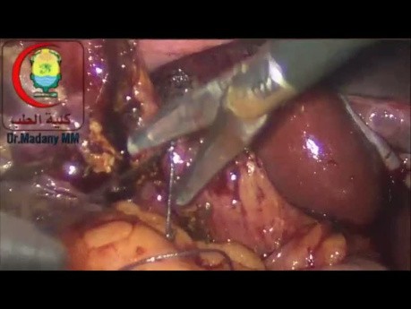 Ligate the Cystic Duct Just Distal to Hartman's Pouch - Running Commentary
