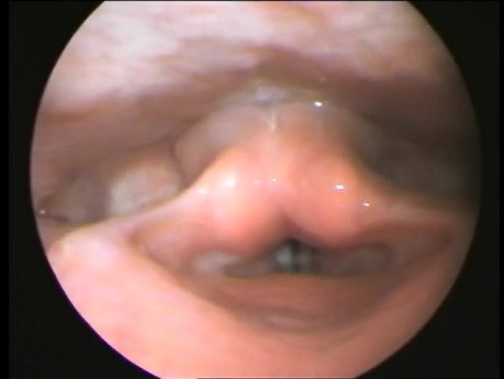 Polyp of a Vocal Cord