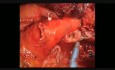 Uniportal Management of Complex Bronchus During Left Upper Lobectomy
