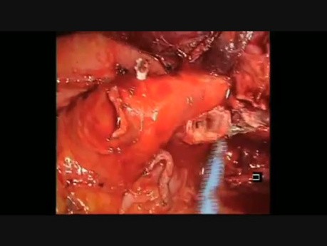 Uniportal Management of Complex Bronchus During Left Upper Lobectomy