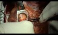 Coronary Artery Bypass Grafting - CABG - Epidural Anaesthesia