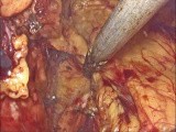 Left Adrenal Laproscopy with Adenoma, Position-Right Lateral Approach - Transperitoneal • Video • MEDtube.net