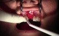 Extraction #9 with GBR-Socket Grafting 