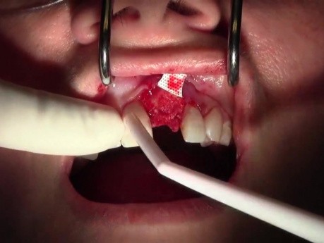 Extraction #9 with GBR-Socket Grafting 