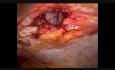 Laparoscopic IPOM