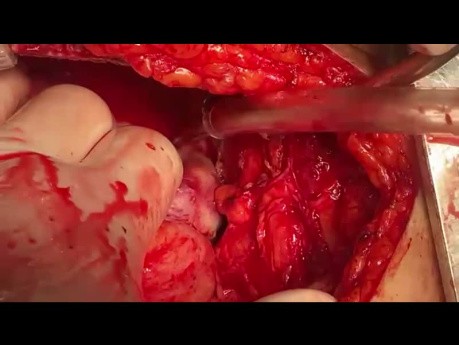 Patient with Previous CMVC and LV Apical Pseudo Aneurysm