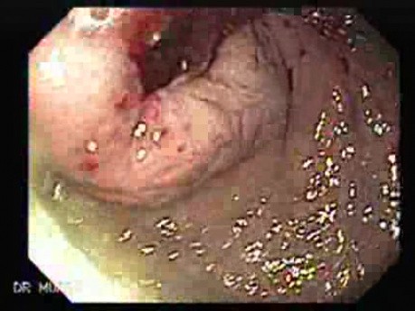 Gastric Adenocarcinoma That Has Been Manifested With Hiccups (2 of 5)