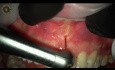 Labial Frenum Removal with Laser YSGG