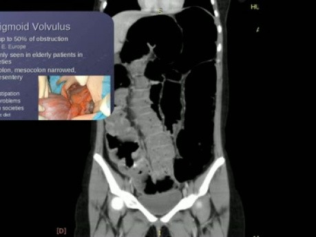 Minimally İnvasive Management of Recurrent Sigmoid Volvulus