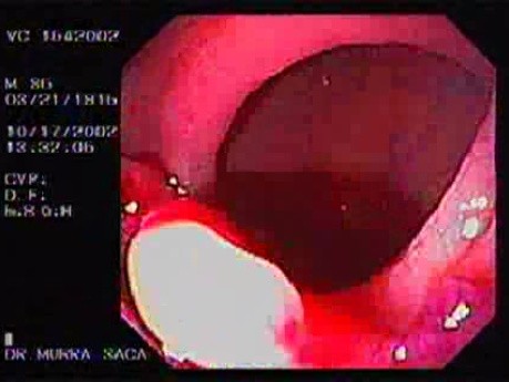 Infiltrates Rectal Adenocarcinoma (2 of 5)