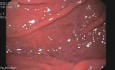 Stage III Of Esophageal Varices - Portal Gastropathy In Gastroscopy