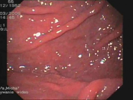 Stage III Of Esophageal Varices - Portal Gastropathy In Gastroscopy