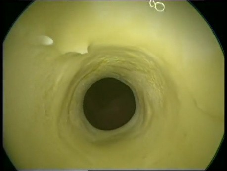 Montgomery T-Tube