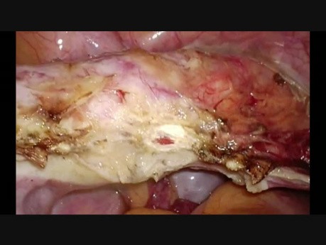 Simple TLH