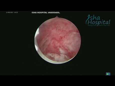 Hysteroscopic Myomectomy Type 1 and 2 