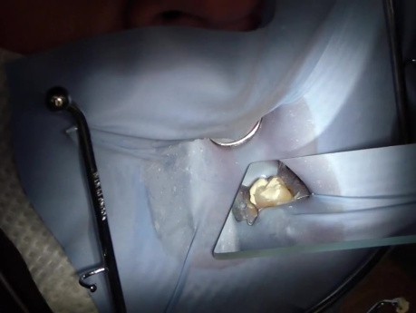 Chemfil - Provisional Restorative Material