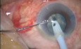 Cataract Surgery - Phacoemulsification - Stop And Chop Technique