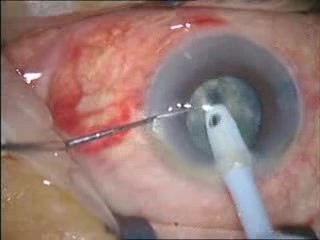 Cataract Surgery - Phacoemulsification - Stop And Chop Technique