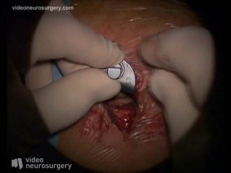 Cervical Arthrodesis - Anterior Approach