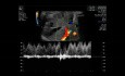 Fetal Ductus Venosus Flow Assessment
