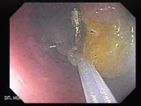 Colonoscopic Polypectomy (13 of 18)