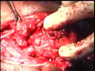 Parotitis Surgery