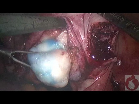 Locating Fibroids During Laparoscopic Myomectomy